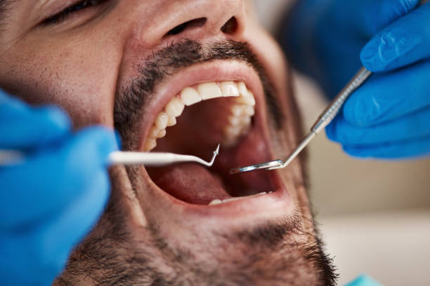 Best Emergency Treatment for Dental Infections or Abscesses in Lima, PA