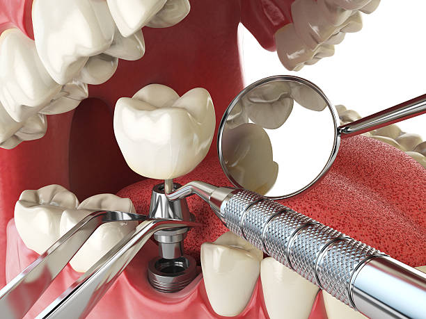 Best Emergency Dental Care for Broken or Chipped Teeth in Lima, PA